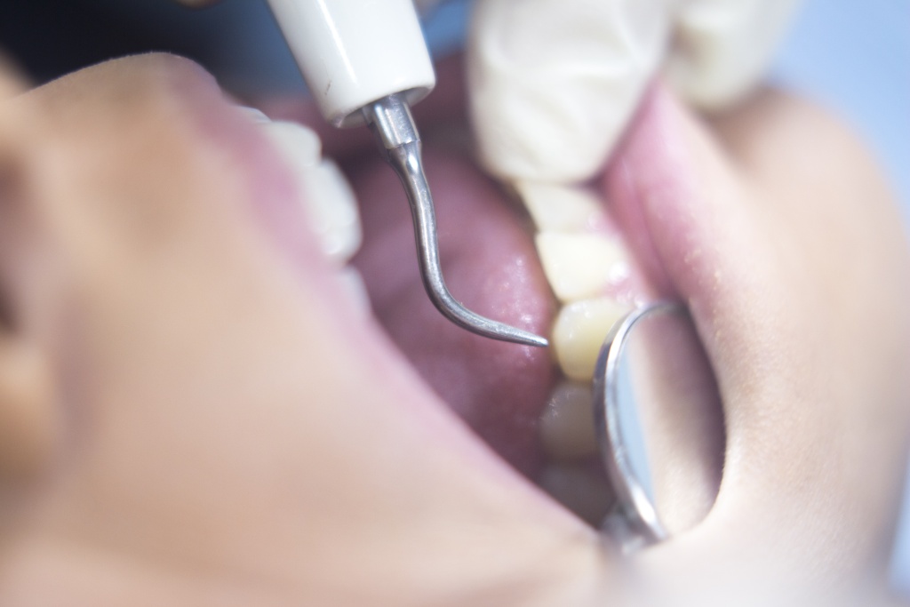 Спрос на наборы для домашнего пломбирования зубов резко вырос