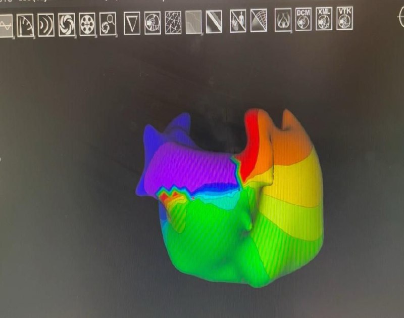 Персонализированный подход в кардиологии: в НМИЦ эндокринологии имени академика Ивана Дедова внедрили инновационный алгоритм лечения аритмии у пациентов с диабетом